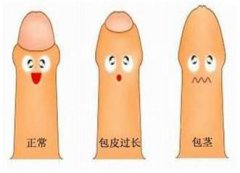 做包皮包茎手术哪家医院好 新乡